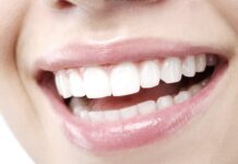 Hollywood Smile in Istanbul: Cost, Process, and Is It Worth It? Bright white smile after Hollywood smile dental treatment in Istanbul